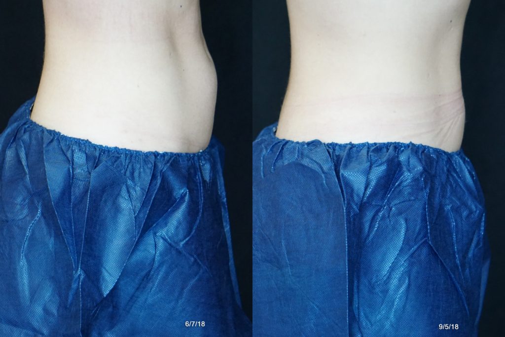 coolsculpting results