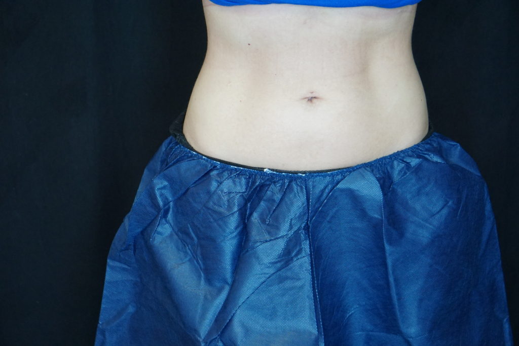 coolsculpting results