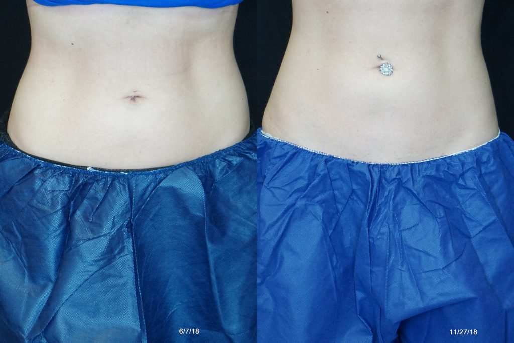coolsculpting results