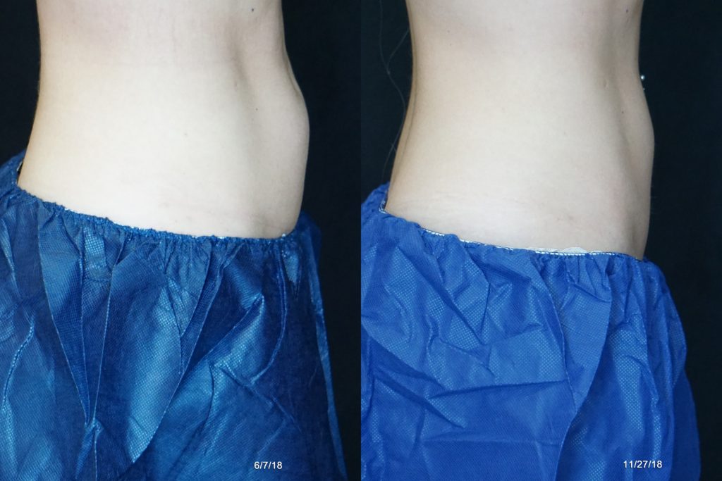 coolsculpting results