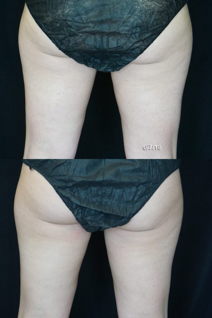 coolsculpting results