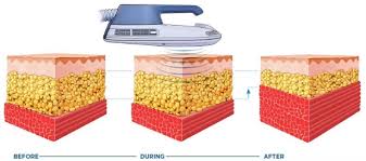 emsculpt technology