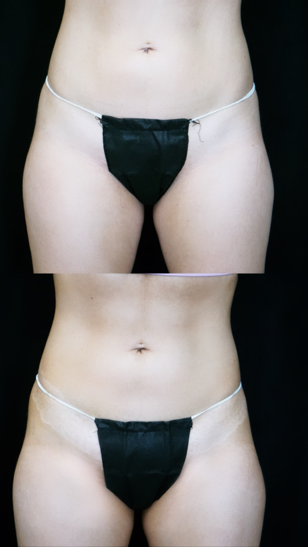 emsculpt abdominal area