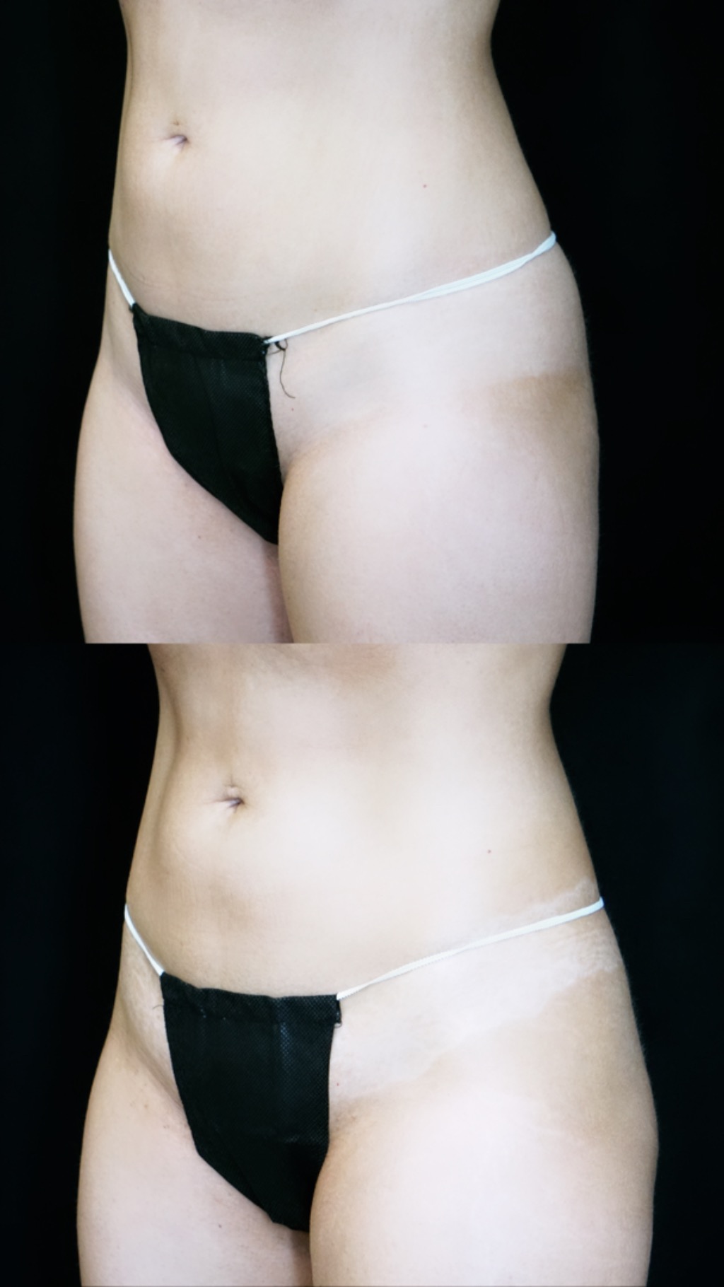 emsculpt abdomen