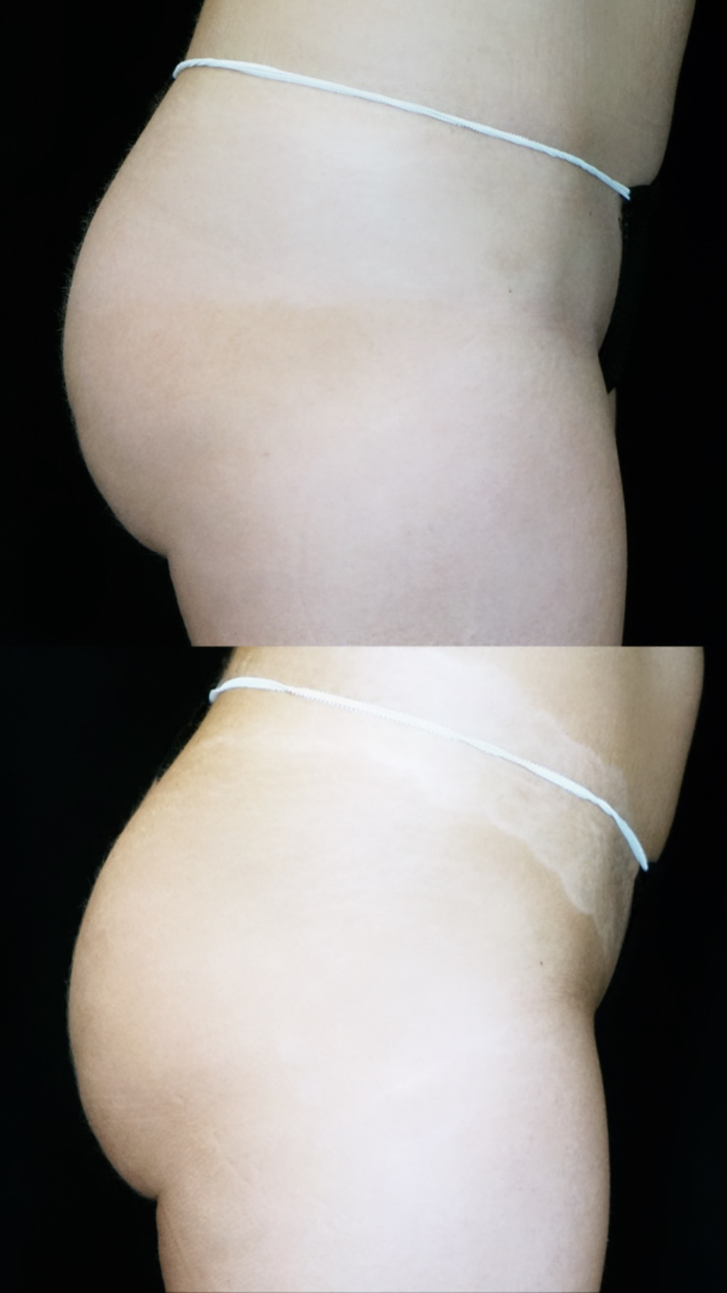 emsculpt buttocks