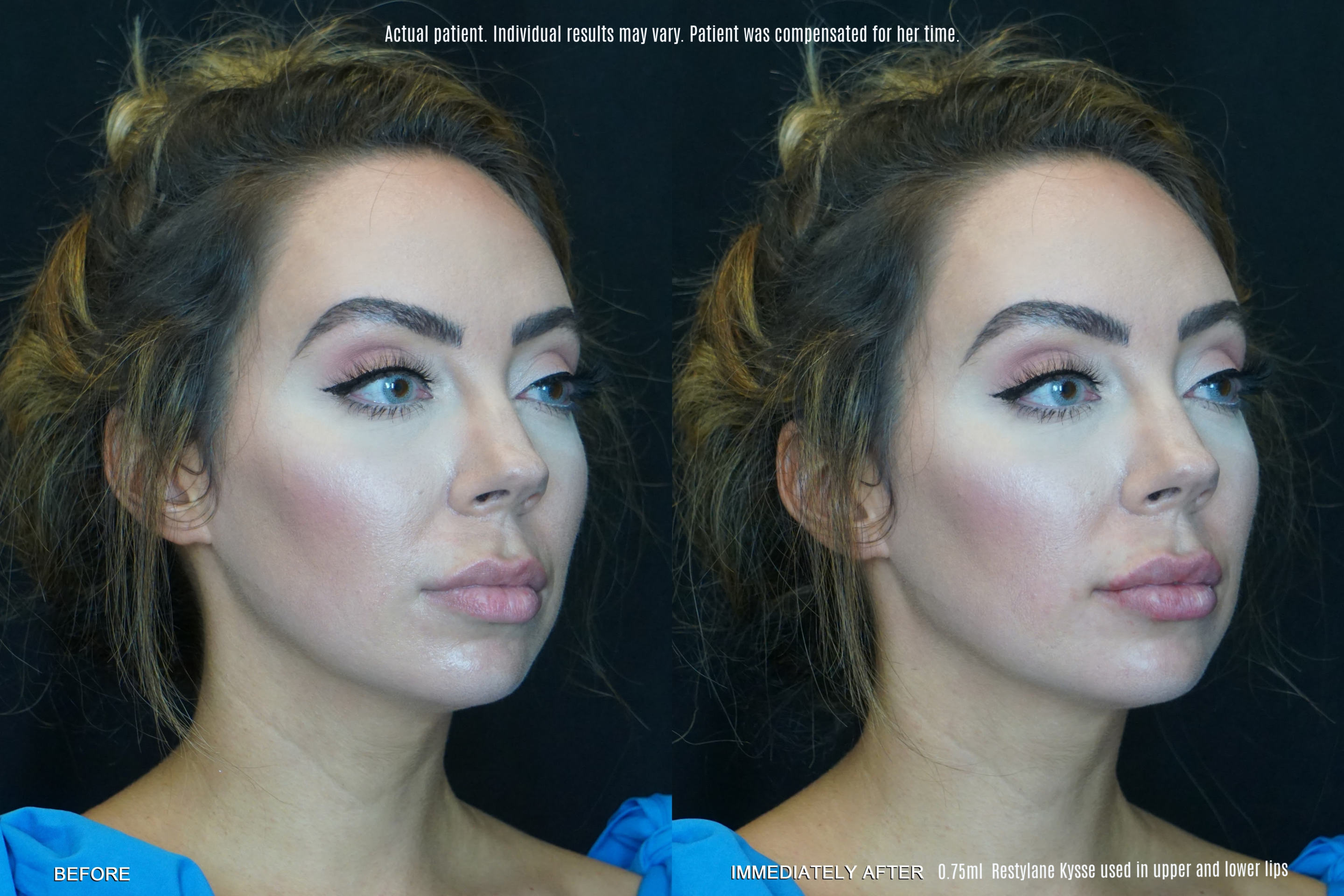 restylane kysse before and after